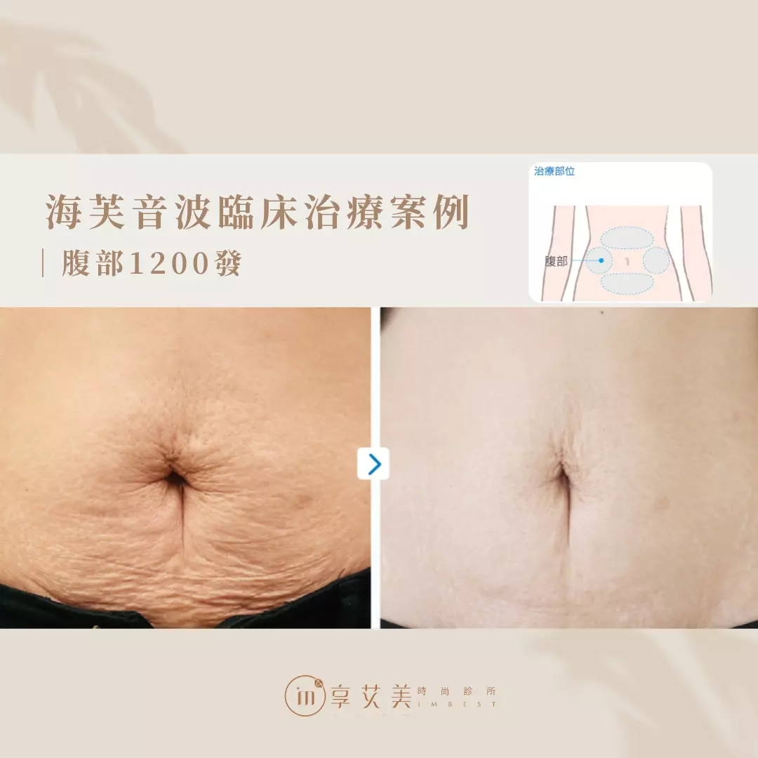 海芙音波｜腹部