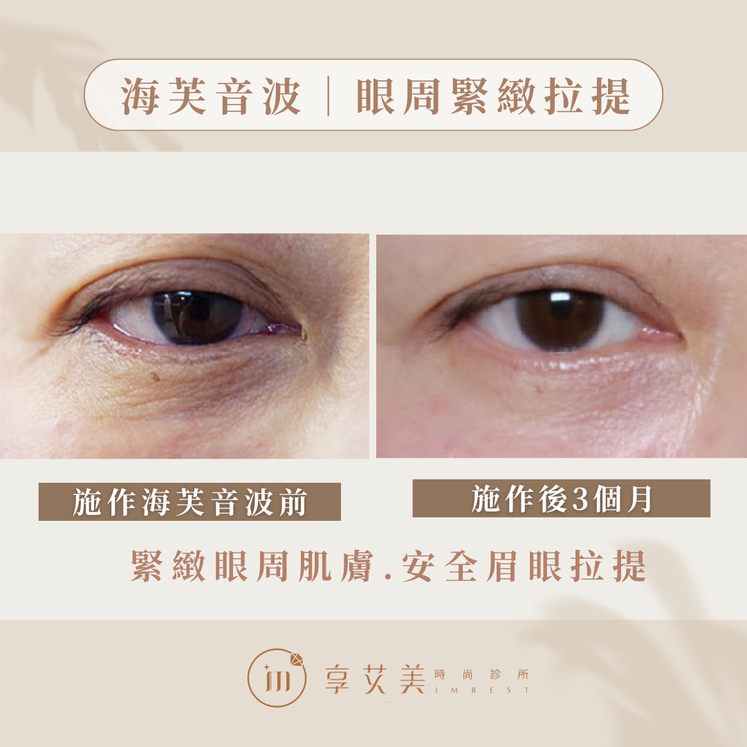 海芙音波｜眼周緊緻拉提