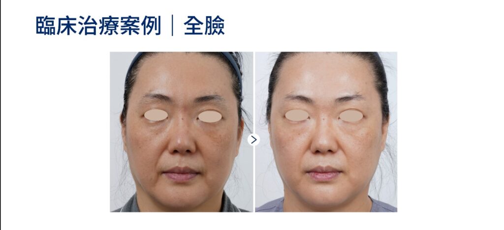 海芙音波媚必提全臉案例