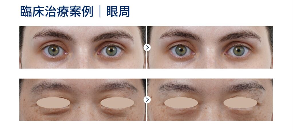 海芙音波媚必提眼周案例