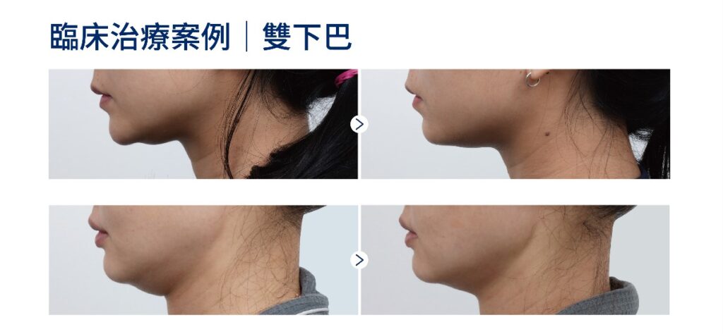 海芙音波媚必提雙下巴案例