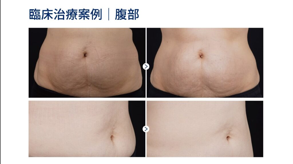 海芙音波媚必提腹部案例