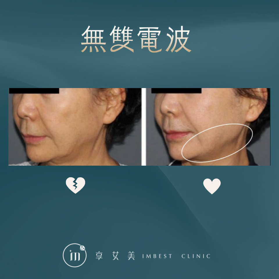 無雙電波案例-1