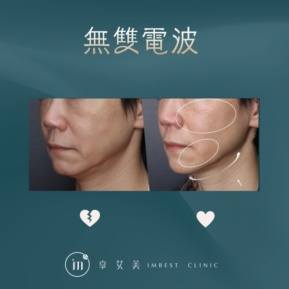 無雙電波案例-2