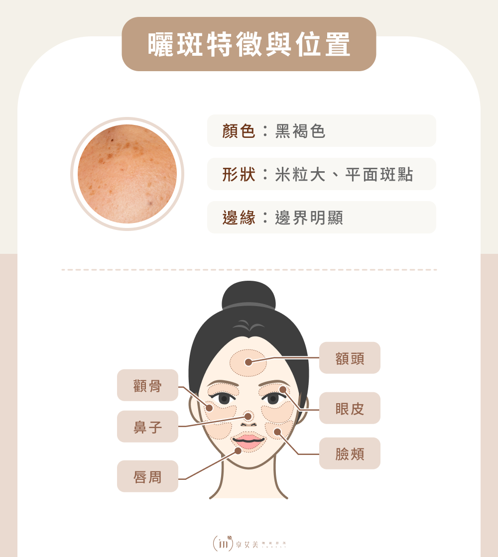 曬斑特徵與位置