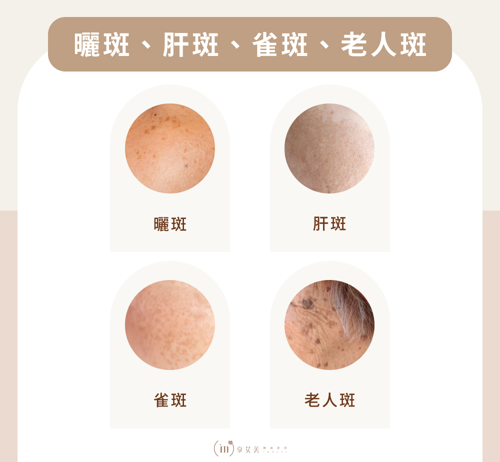 曬斑、肝斑、雀斑、老人斑